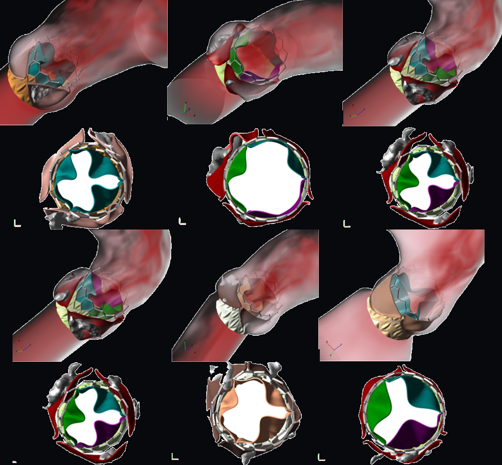 Multiple patient-specific anatomies and implanted valve configurations shown from side and en-face views.